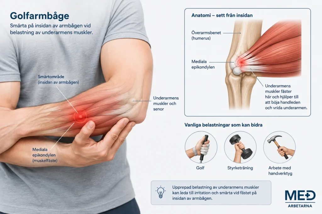 Medicinsk illustration av golfarmbåge med smärtområdet på armbågens insida och underarmens muskler och senfästen markerade
