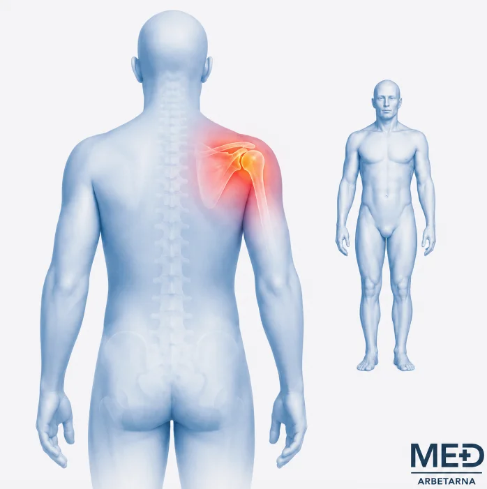 Medicinsk illustration av axelluxation med axelleden markerad framifrån och bakifrån