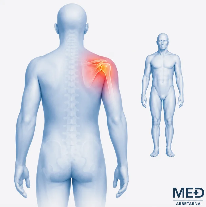 Anatomisk illustration av frozen shoulder där axelleden är markerad med röd smärthighlight på en blåtonad människokropp.