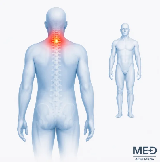 Anatomisk illustration av nackdiskbråck där halsryggen är markerad med röd och gul smärthighlight på en blåtonad människokropp.